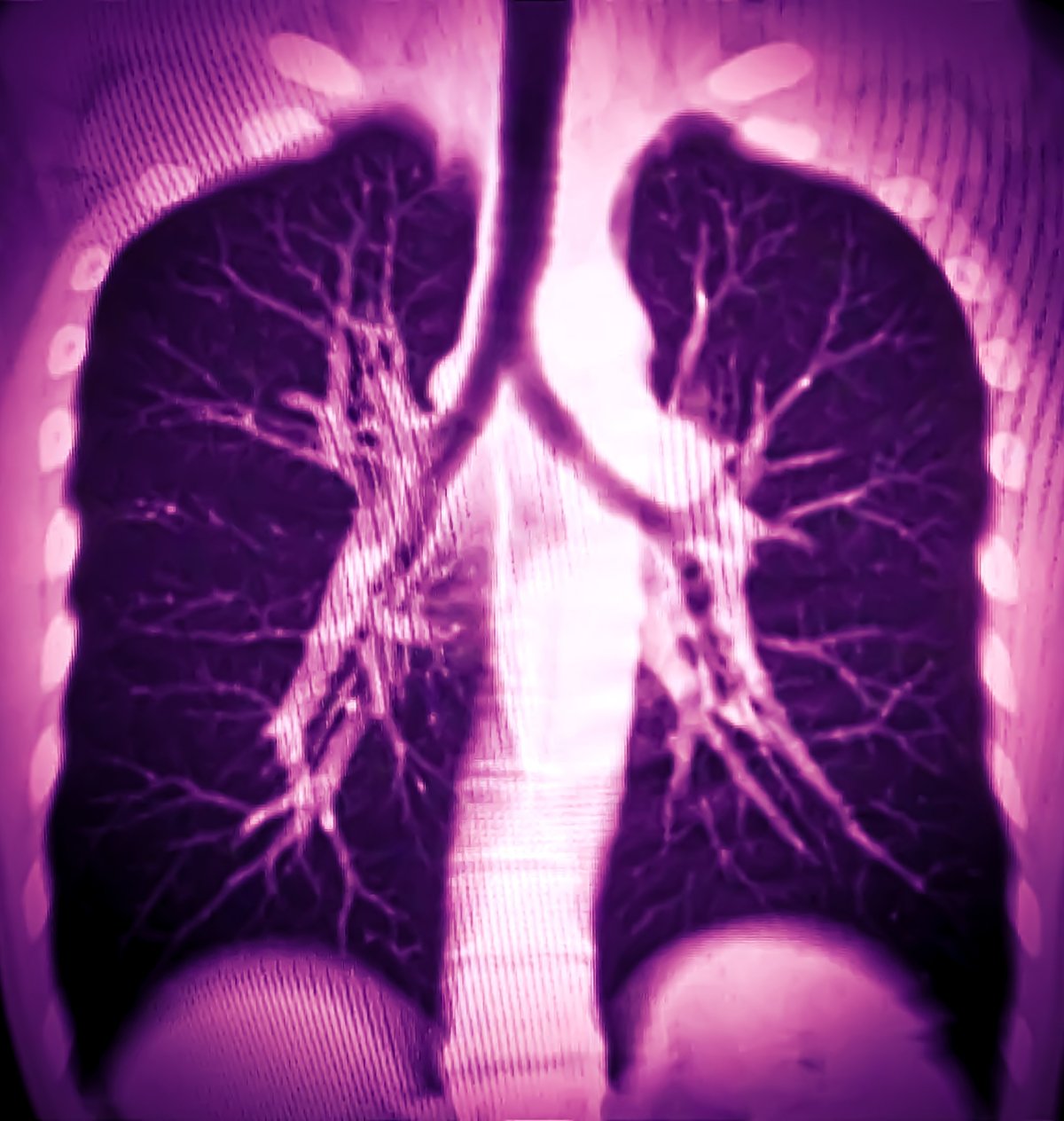 High-resolution computed tomography scan of the chest showing detailed cross-sectional images of the lungs.