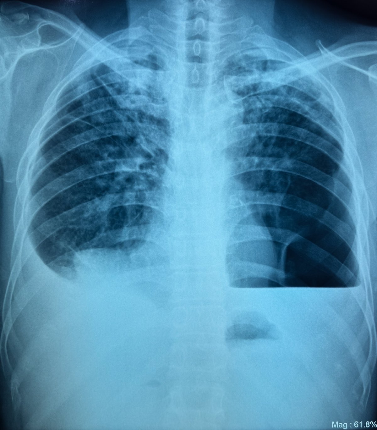 Medical X-ray image of a human chest showing the lungs, used for diagnosing lung conditions.